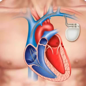 Pacemaker Implantation